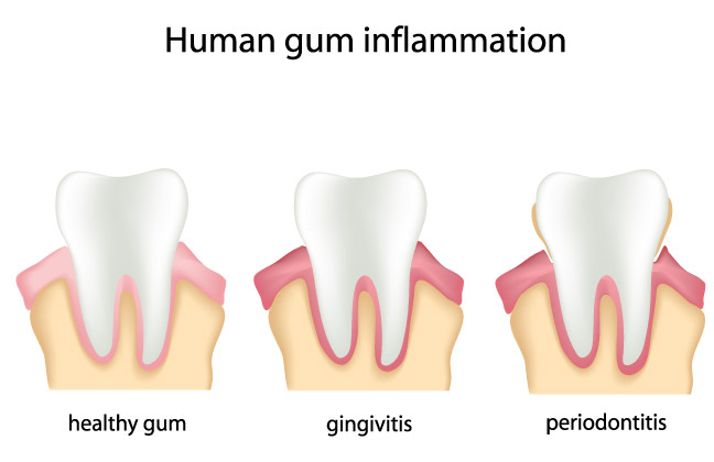 gum-disease-large2